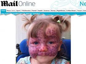 Doença rara deixa criança com manchas na pele e convulsões