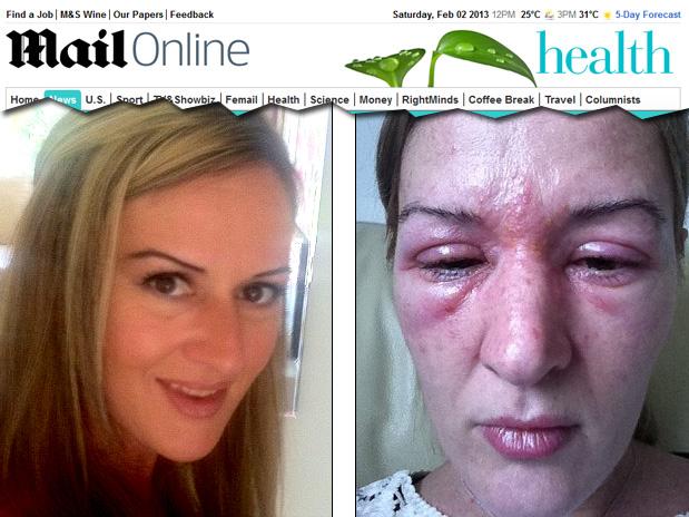 Mulher arranca extensão de cílios após alergia